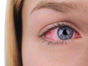 Image of a girl with pink eye.