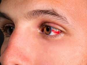 Image of an occlusion causing redness in eyes.