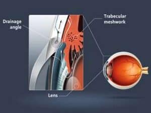 Cartoon image of glaucoma.