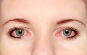 Image of a woman's red eyes.