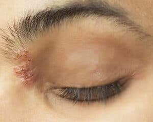 skin lesion on eye area