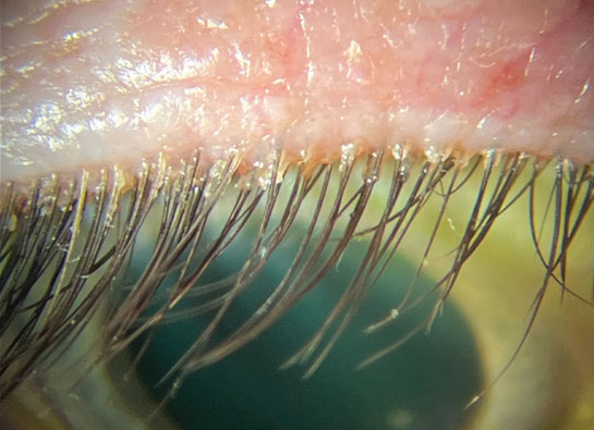What is Demodex