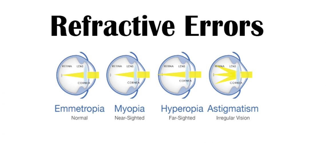 refractive error (myopia hyperopia astigmatism)
