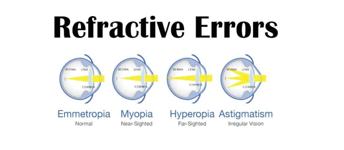 Refractive Errors